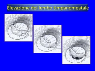 Elevazione del lembo timpanomeatale
 