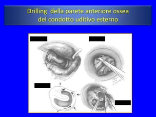 Drilling della parete anteriore ossea
     del condotto uditivo esterno
 