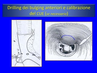 Drilling dei bulging anteriori e calibrazione
             del CUE (se necessario)




                (*)
 