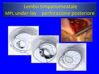 Lembo timpanomeatale
MPL under-lay - perforazione posteriore




        (*)




                              (*)
 