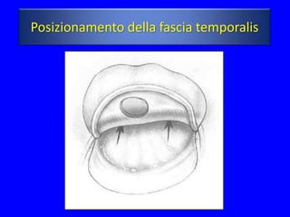 Posizionamento della fascia temporalis
 