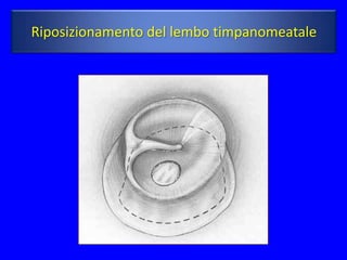 Riposizionamento del lembo timpanomeatale
 