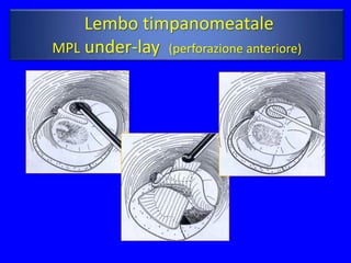 Lembo timpanomeatale
MPL under-lay (perforazione anteriore)
 