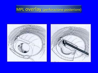 MPL overlay (perforazione posteriore)




                                        (*)
 