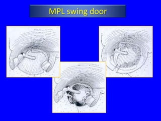 MPL swing door
 