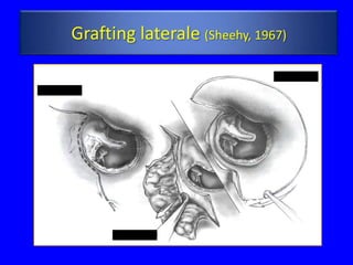 Grafting laterale (Sheehy, 1967)
 