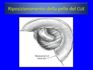 Riposizionamento della pelle del CUE
 