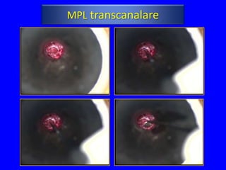 MPL transcanalare
 