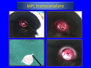MPL transcanalare
 