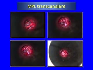 MPL transcanalare
 