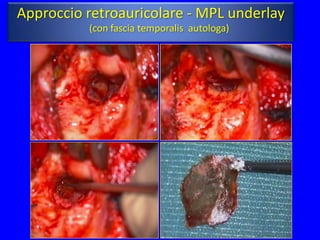 Approccio retroauricolare - MPL underlay
          (con fascia temporalis autologa)
 