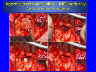 Approccio retroauricolare - MPL underlay
          (con fascia temporalis autologa)
 