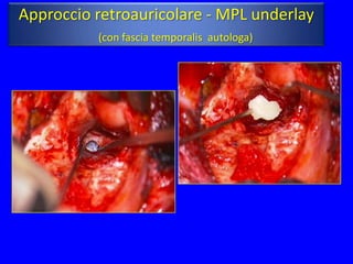 Approccio retroauricolare - MPL underlay
          (con fascia temporalis autologa)
 