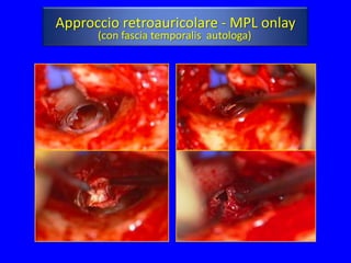 Approccio retroauricolare - MPL onlay
      (con fascia temporalis autologa)
 