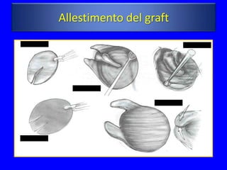 Allestimento del graft
 