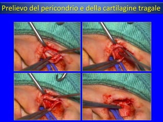Prelievo del pericondrio e della cartilagine tragale
 