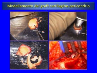 Modellamento del graft cartilagine-pericondrio
 