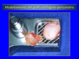 Modellamento del graft cartilagine-pericondrio
 