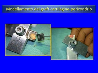 Modellamento del graft cartilagine-pericondrio
 