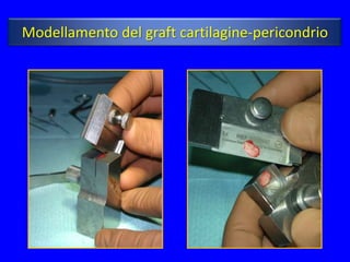 Modellamento del graft cartilagine-pericondrio
 