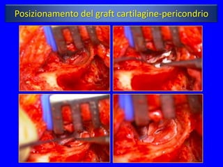Posizionamento del graft cartilagine-pericondrio
 