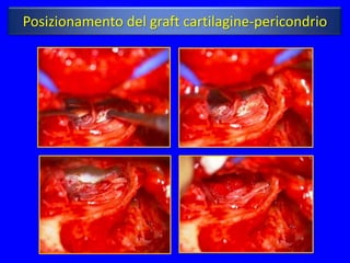 Posizionamento del graft cartilagine-pericondrio
 