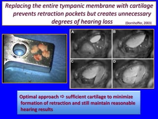 Replacing the entire tympanic membrane with cartilage
  prevents retraction pockets but creates unnecessary
                 degrees of hearing loss    (Dornhoffer, 2003)




     Optimal approach  sufficient cartilage to minimize
     formation of retraction and still maintain reasonable
     hearing results
 