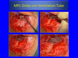 MPL Onlay con Ventilation Tube
 