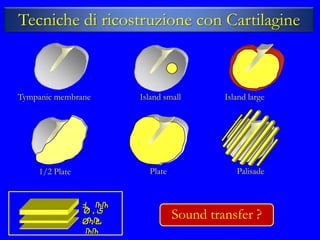 Tecniche di ricostruzione con Cartilagine



Tympanic membrane      Island small       Island large




    1/2 Plate            Plate               Palisade


                1 mm
                0,5
                 mm
                0,2
                                 Sound transfer ?
                 mm
 