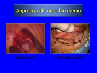 Approccio all’ orecchio medio




Endoaurale       Retroauricolare
 