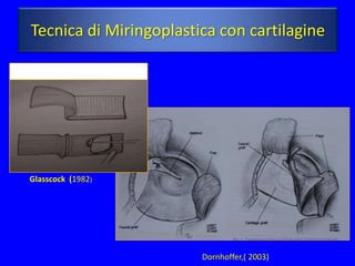 Tecnica di Miringoplastica con cartilagine

Perichondrium-cartilage island flap




   Glasscock (1982)




                                      Dornhoffer,( 2003)
 