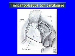 Timpanoplastica con cartilagine
 