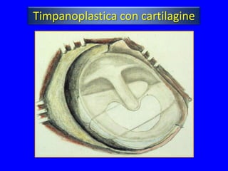 Timpanoplastica con cartilagine
 