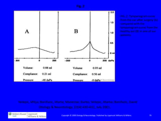 Fig. 2

                                                                                                   FIG. 2. Tympanogram curve
                                                                                                   from the ear after surgery (A)
                                                                                                   compared with the
                                                                                                   tympanogram curve from the
                                                                                                   healthy ear (B) in one of our
                                                                                                   patients.




                                         Cartilage Palisade Tympanoplasty and Diving

Velepic, Mitja; Bonifacic, Marta; Manestar, Darko; Velepic, Marko; Bonifacic, David
               Otology & Neurotology. 22(4):430-432, July 2001.

                              Copyright © 2009 Otology & Neurotology. Published by Lippincott Williams & Wilkins.         79
 