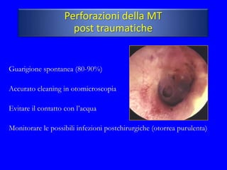 Perforazioni della MT
                     post traumatiche


Guarigione spontanea (80-90%)

Accurato cleaning in otomicroscopia

Evitare il contatto con l’acqua

Monitorare le possibili infezioni postchirurgiche (otorrea purulenta)
 