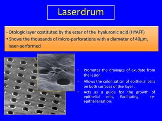 Laserdrum
• Otologic layer costituted by the ester of the
                                            hyaluronic acid (HYAFF)
• Shows the thousands of micro-perforations with a diameter of 40μm,
 laser-performed



                                     •   Promotes the drainage of exudate from
                                         the lesion
                                     •   Allows the colonization of epithelial cells
                                         on both surfaces of the layer .
                                     •   Acts as a guide for the growth of
                                         epithelial cells, facilitating         re-
                                         epithelialization:
 
