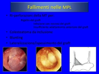Fallimenti nelle MPL
• Ri-perforazioni della MT per:
         Rigetto del graft
                   Infezione con necrosi del graft
                   Insufficiente adattamento anteriore del graft
• Colesteatoma da inclusione
• Blunting
• Lateralizzazione/ispessimento del graft
 
