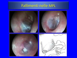 Fallimenti nelle MPL
 