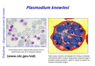 Paludisme:diagnostiqueravantdetraiter
Plasmodium knowlesi
(www.cdc.gov/eid) False-colour electron micrograph of a rhesus red blood
cell infected with a mature segmented schizont-stage P.
knowlesi malaria parasite, which is about to release its
invasive merozoite stages.
A thin blood smear stained with Giesma from a
fatal human case of P. knowlesi malaria
 