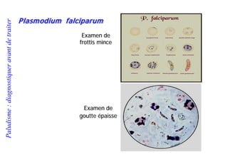 Paludisme:diagnostiqueravantdetraiter
Examen de
frottis mince
Examen de
goutte épaisse
Plasmodium falciparum
 