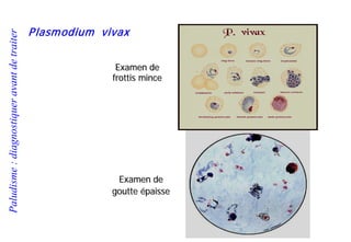 Paludisme:diagnostiqueravantdetraiter
Plasmodium vivax
Examen de
frottis mince
Examen de
goutte épaisse
 