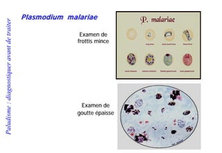 Paludisme:diagnostiqueravantdetraiter
Plasmodium malariae
Examen de
frottis mince
Examen de
goutte épaisse
 