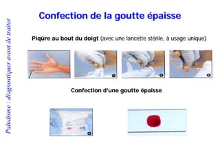 Paludisme:diagnostiqueravantdetraiter
Confection de la goutte épaisse
Piqûre au bout du doigt (avec une lancette stérile, à usage unique)
Confection d’une goutte épaisse
 
