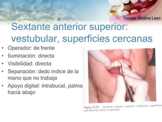 Natalia Medina Lazo

    Sextante anterior superior:
    vestubular, superficies cercanas
• Operador: de frente
• Iluminación: directa
• Visibilidad: directa
• Separación: dedo índice de la
  mano que no trabaja
• Apoyo digital: intrabucal, palma
  hacia abajo
 