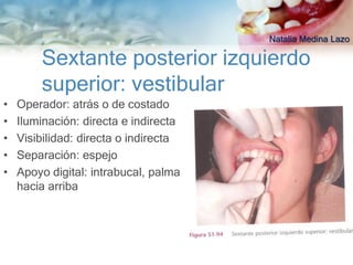 Natalia Medina Lazo

        Sextante posterior izquierdo
        superior: vestibular
•   Operador: atrás o de costado
•   Iluminación: directa e indirecta
•   Visibilidad: directa o indirecta
•   Separación: espejo
•   Apoyo digital: intrabucal, palma
    hacia arriba
 