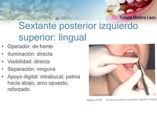 Natalia Medina Lazo

        Sextante posterior izquierdo
        superior: lingual
•   Operador: de frente
•   Iluminación: directa
•   Visibilidad: directa
•   Separación: ninguna
•   Apoyo digital: intrabucal, palma
    hacia abajo, arco opuesto,
    reforzado
 