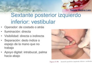 Natalia Medina Lazo

       Sextante posterior izquierdo
       inferior: vestibular
• Operador: de costado o atrás
• Iluminación: directa
• Visibilidad: directa o indirecta
• Separación: dedo índice o
  espejo de la mano que no
  trabaja
• Apoyo digital: intrabucal, palma
  hacia abajo
 