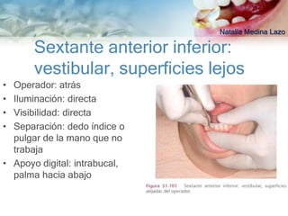 Natalia Medina Lazo

       Sextante anterior inferior:
       vestibular, superficies lejos
• Operador: atrás
• Iluminación: directa
• Visibilidad: directa
• Separación: dedo índice o
  pulgar de la mano que no
  trabaja
• Apoyo digital: intrabucal,
  palma hacia abajo
 