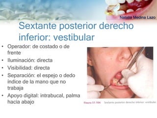 Natalia Medina Lazo

       Sextante posterior derecho
       inferior: vestibular
• Operador: de costado o de
  frente
• Iluminación: directa
• Visibilidad: directa
• Separación: el espejo o dedo
  índice de la mano que no
  trabaja
• Apoyo digital: intrabucal, palma
  hacia abajo
 