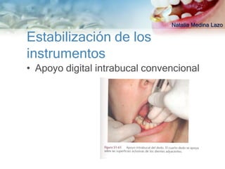 Natalia Medina Lazo

Estabilización de los
instrumentos
• Apoyo digital intrabucal convencional
 